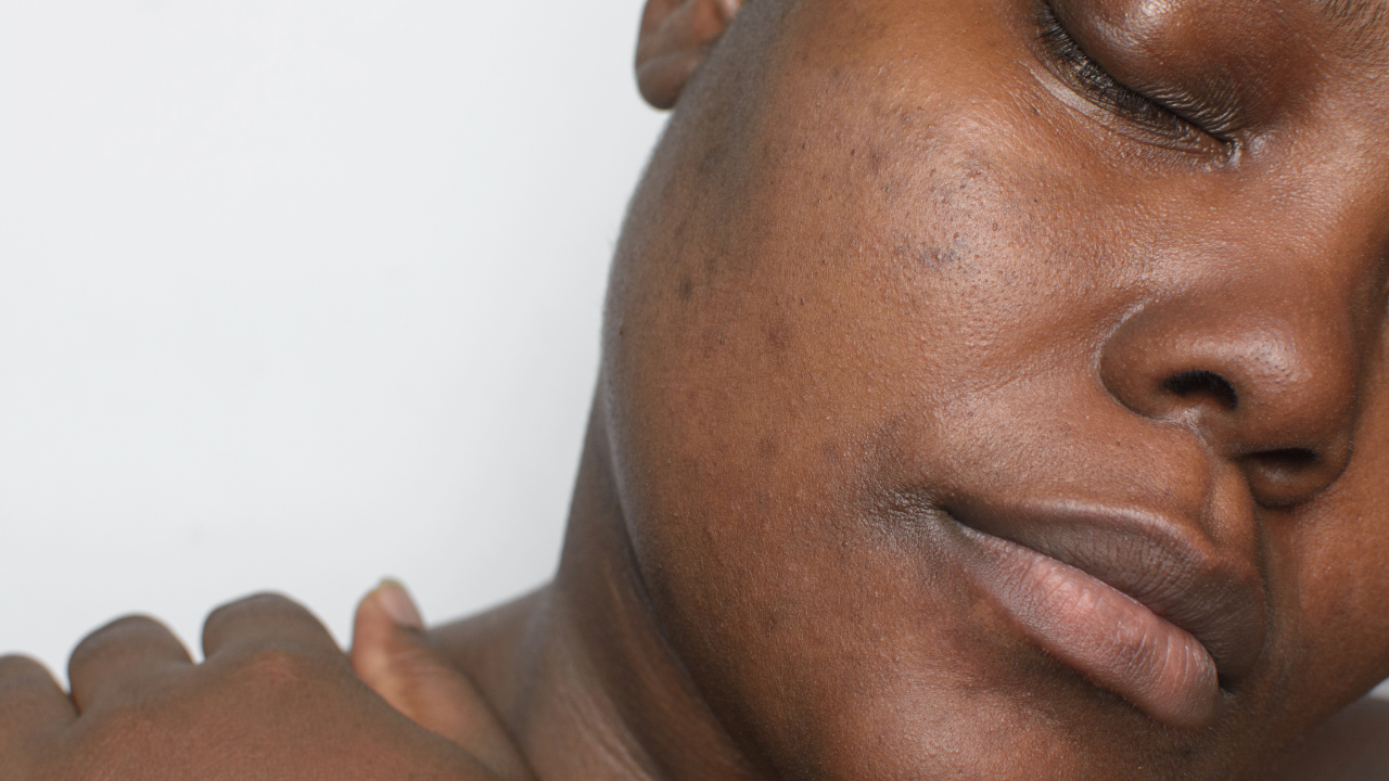 Key ingredients for treating stubborn hyperpigmentation include Vitamin C, Kojic acid, and Mandelic acid